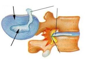 Distrugerea inelului fibros cu osteocondroză cervicală
