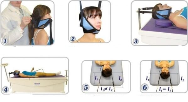 Tratamentul osteochondrozei cervicale cu eliminare